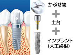 インプラントの構造